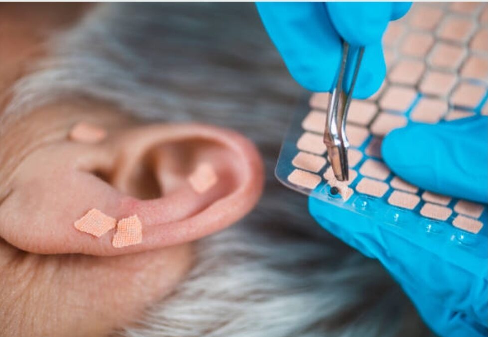 Auriculoterapia